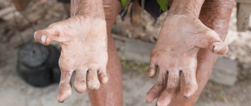 increasing-leprosy-cases-central-florida-identified-as-an-emerging-area-for-the-disease